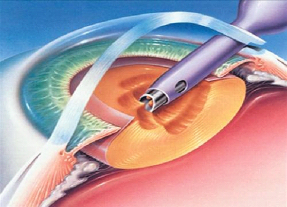 Cataract image 1