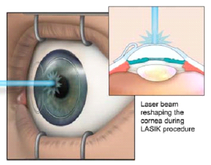 Lasik image 1